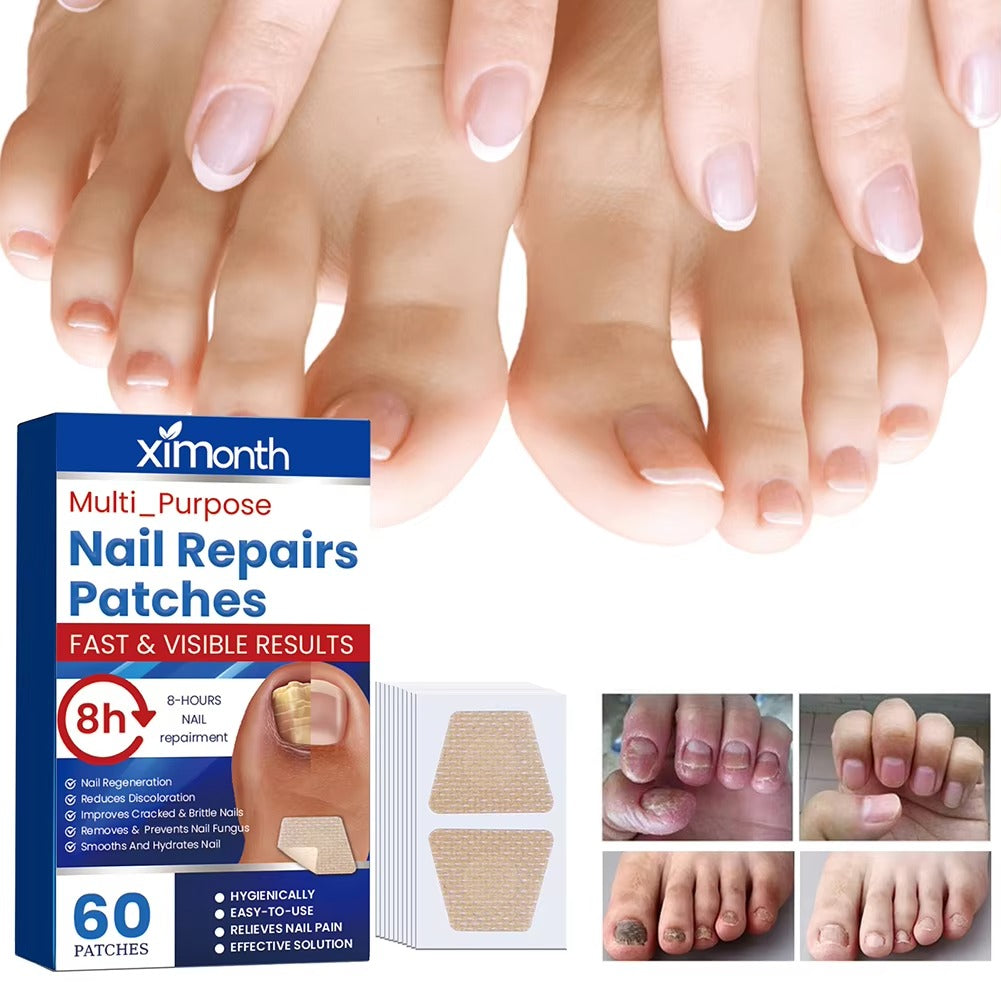 Επιθέματα επανόρθωσης νυχιών Nail Nurture™ κατά της μυκητίασης των νυχιών