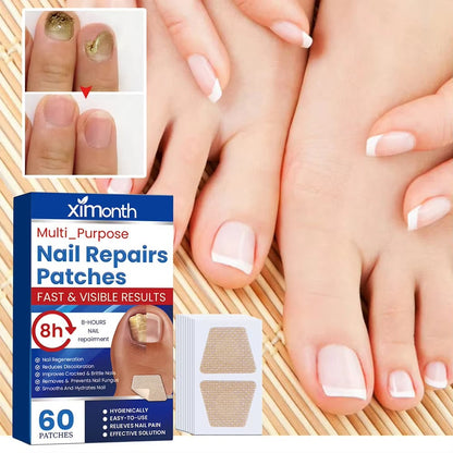 Επιθέματα επανόρθωσης νυχιών Nail Nurture™ κατά της μυκητίασης των νυχιών